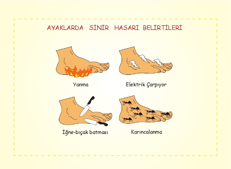 AYAKLARDA SİNİR HASARI BELİRTİLERİ Yanma İğne-bıçak batması Elektrik Çarpıyor Karıncalanma 