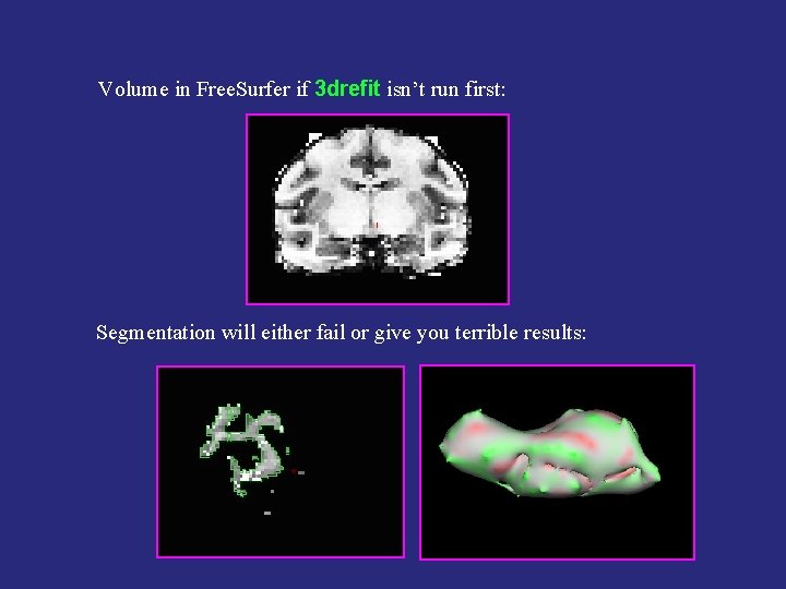 Volume in Free. Surfer if 3 drefit isn’t run first: Segmentation will either fail
