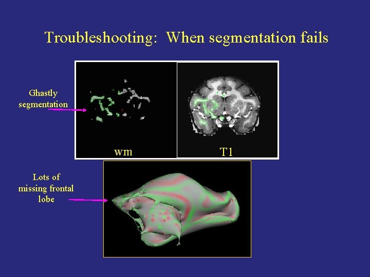 Troubleshooting: When segmentation fails Ghastly segmentation wm Lots of missing frontal lobe T 1