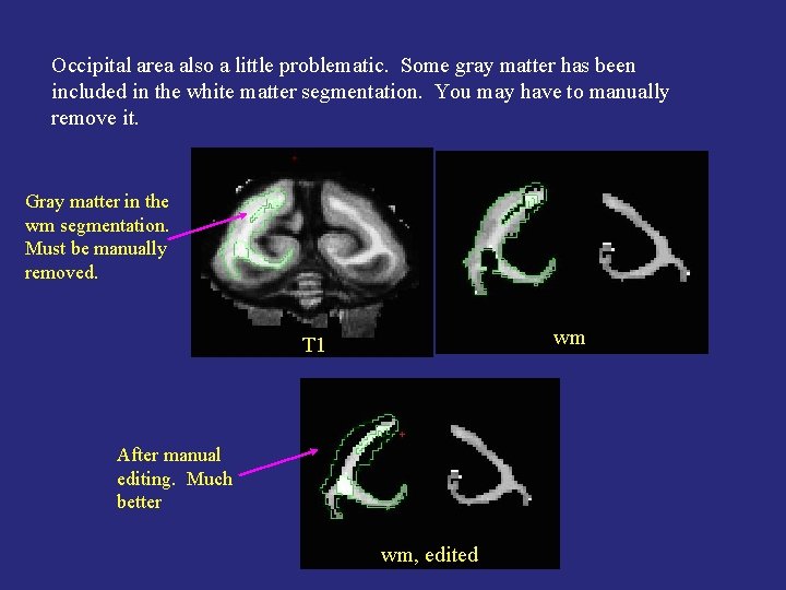 Occipital area also a little problematic. Some gray matter has been included in the