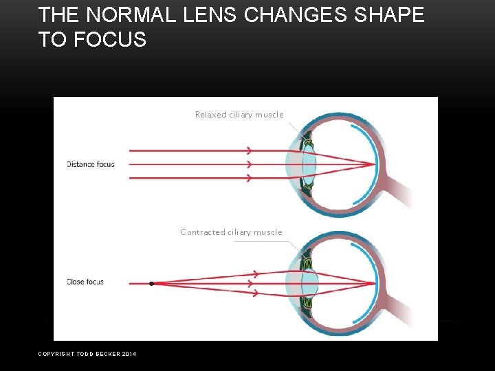 THE NORMAL LENS CHANGES SHAPE TO FOCUS Relaxed ciliary muscle Contracted ciliary muscle COPYRIGHT