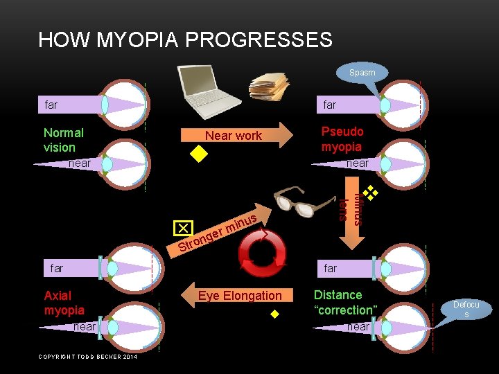 HOW MYOPIA PROGRESSES Spasm far Normal vision near Pseudo myopia Near work u near