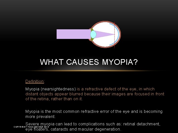 WHAT CAUSES MYOPIA? Definition: Myopia (nearsightedness) is a refractive defect of the eye, in