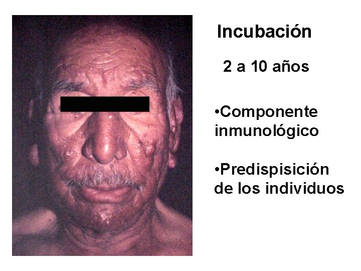 Incubación 2 a 10 años • Componente inmunológico • Predispisición de los individuos 