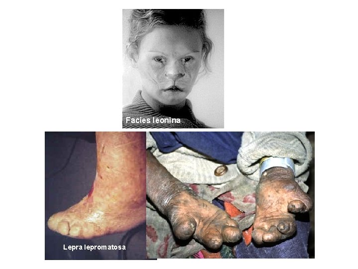 Facies leonina Lepra lepromatosa 