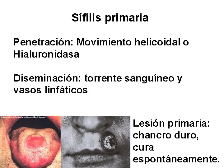 Sífilis primaria Penetración: Movimiento helicoidal o Hialuronidasa Diseminación: torrente sanguíneo y vasos linfáticos Lesión