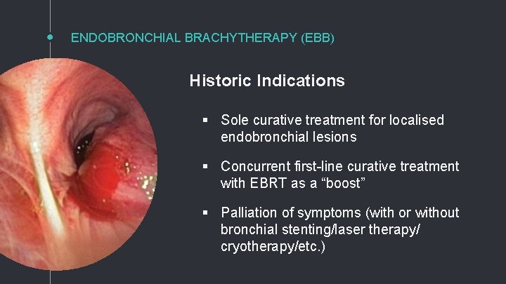 ENDOBRONCHIAL BRACHYTHERAPY (EBB) Historic Indications § Sole curative treatment for localised endobronchial lesions §