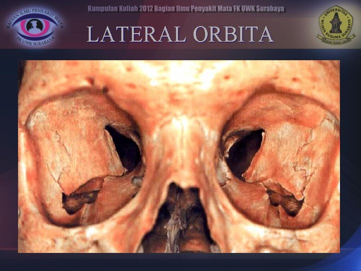 LATERAL ORBITA 