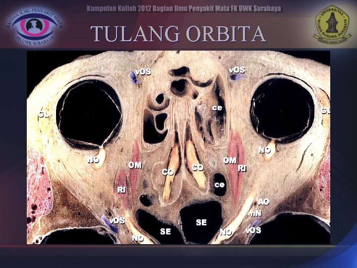 TULANG ORBITA 