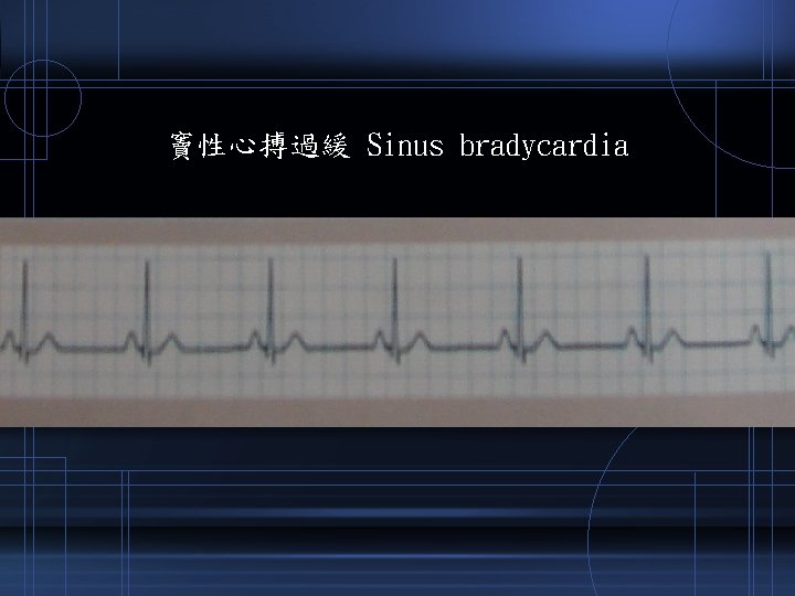 竇性心搏過緩 Sinus bradycardia 