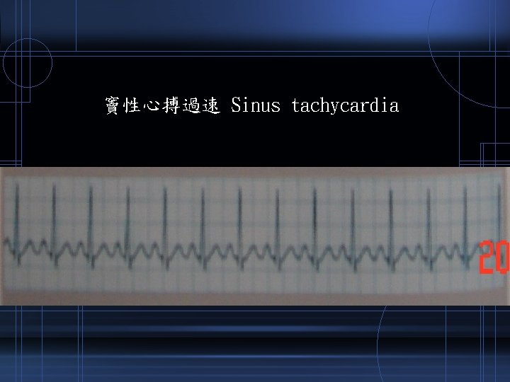 竇性心搏過速 Sinus tachycardia 