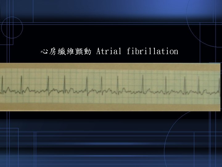 心房纖維顫動 Atrial fibrillation 