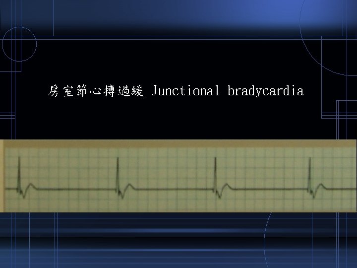 房室節心搏過緩 Junctional bradycardia 
