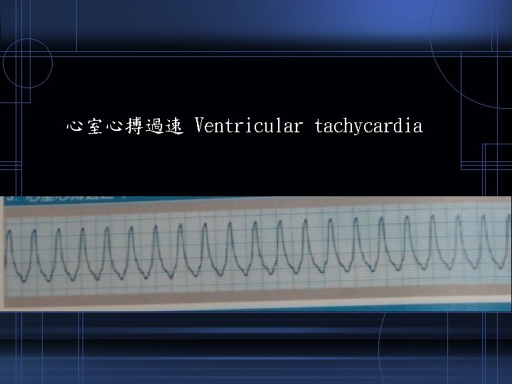 心室心搏過速 Ventricular tachycardia 