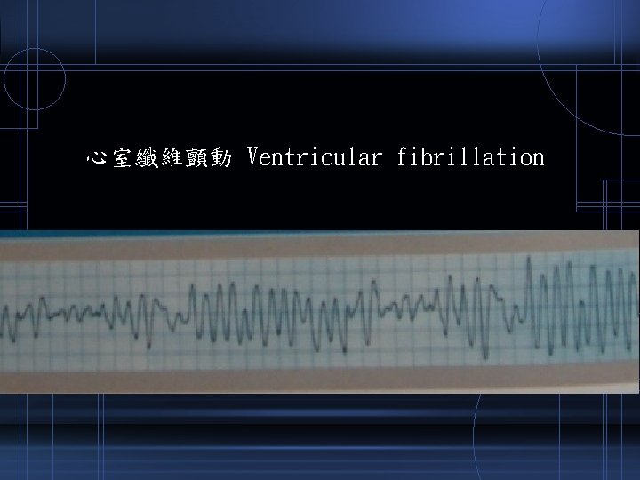 心室纖維顫動 Ventricular fibrillation 