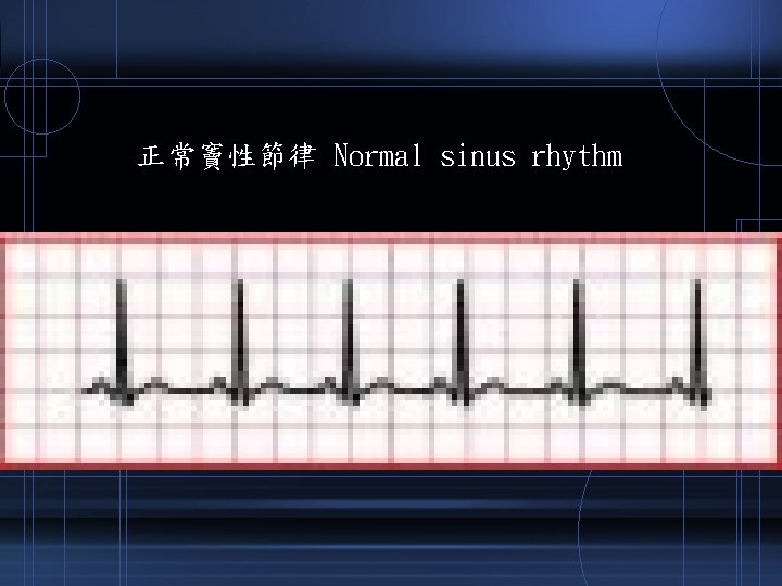 正常竇性節律 Normal sinus rhythm 