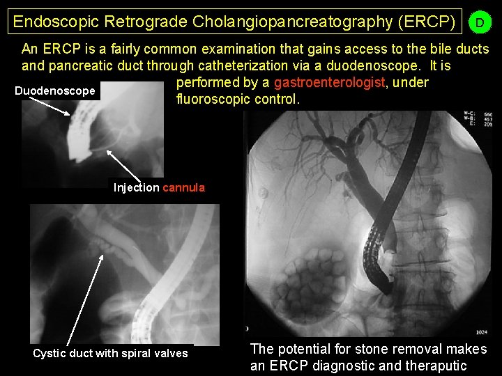 Endoscopic Retrograde Cholangiopancreatography (ERCP) D An ERCP is a fairly common examination that gains
