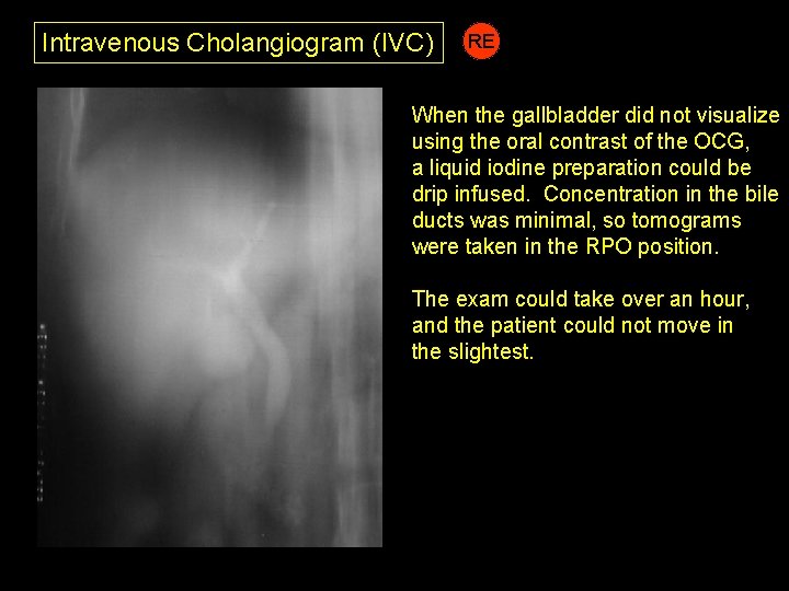 Intravenous Cholangiogram (IVC) RE When the gallbladder did not visualize using the oral contrast