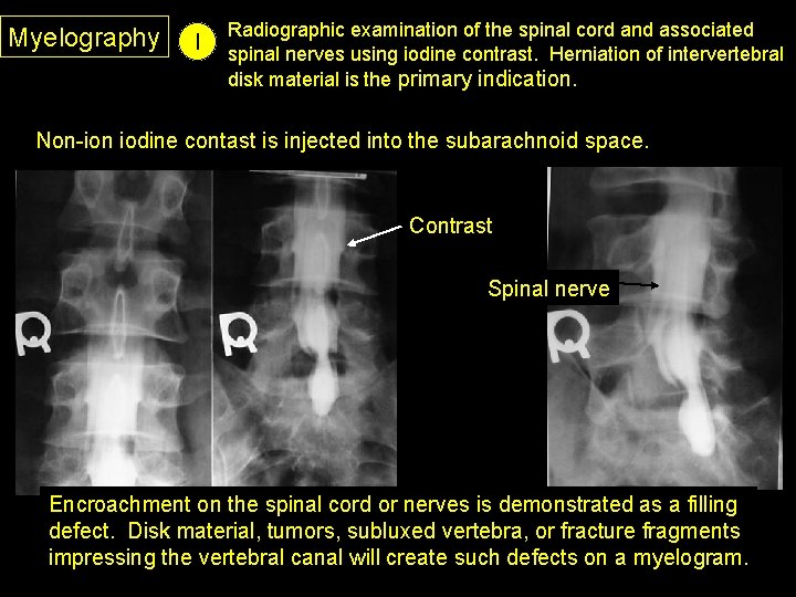 Myelography I Radiographic examination of the spinal cord and associated spinal nerves using iodine