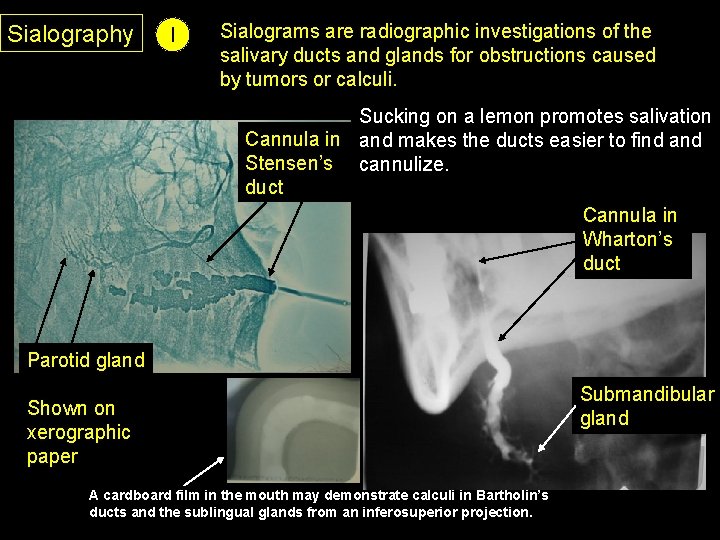 Sialography I Sialograms are radiographic investigations of the salivary ducts and glands for obstructions