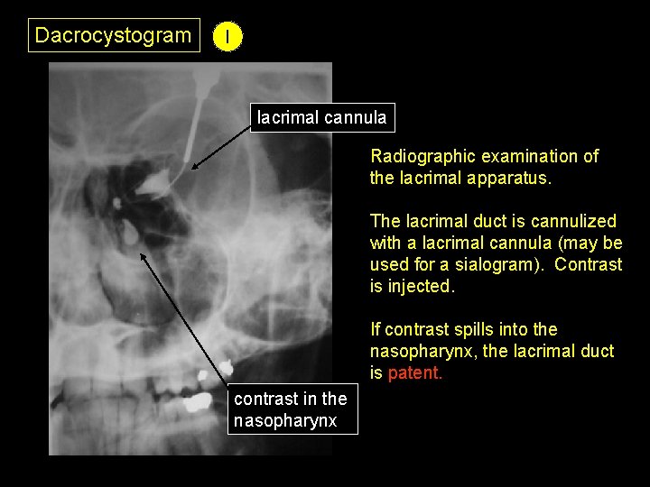 Dacrocystogram I lacrimal cannula Radiographic examination of the lacrimal apparatus. The lacrimal duct is