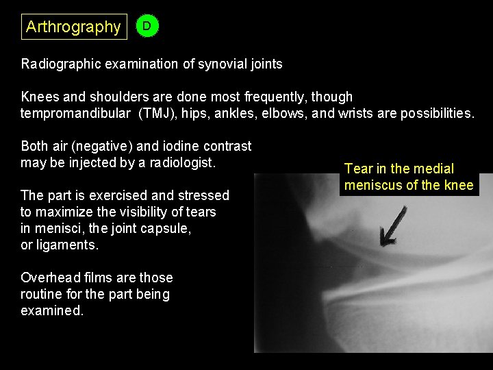 Arthrography D Radiographic examination of synovial joints Knees and shoulders are done most frequently,