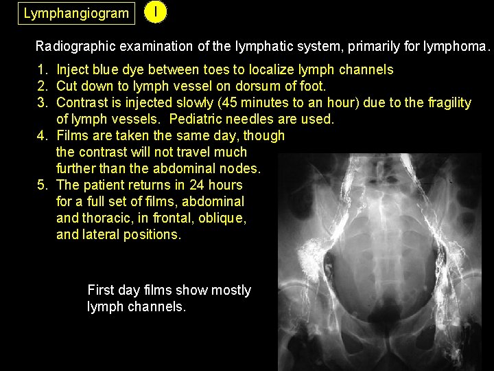 Lymphangiogram I Radiographic examination of the lymphatic system, primarily for lymphoma. 1. Inject blue