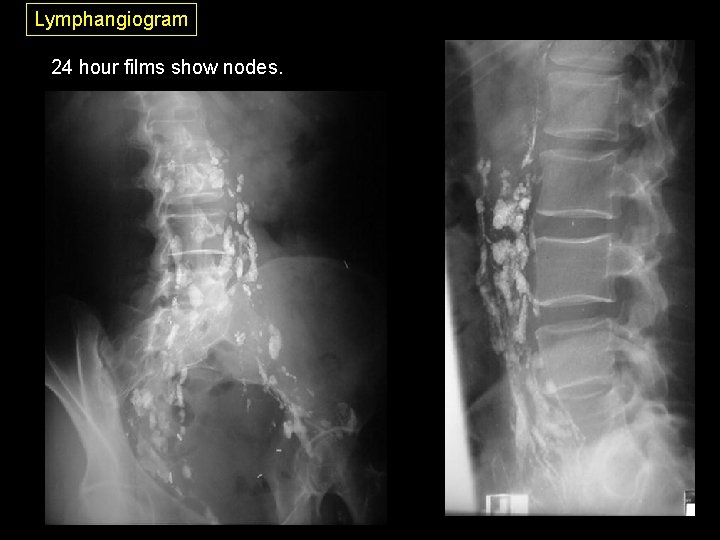 Lymphangiogram 24 hour films show nodes. 