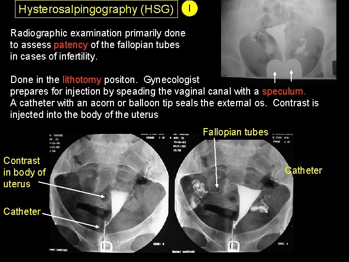 Hysterosalpingography (HSG) I Radiographic examination primarily done to assess patency of the fallopian tubes