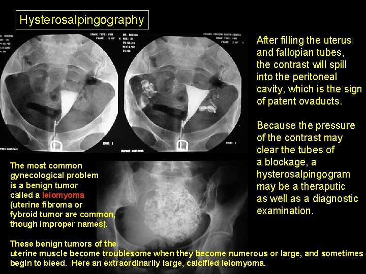 Hysterosalpingography After filling the uterus and fallopian tubes, the contrast will spill into the