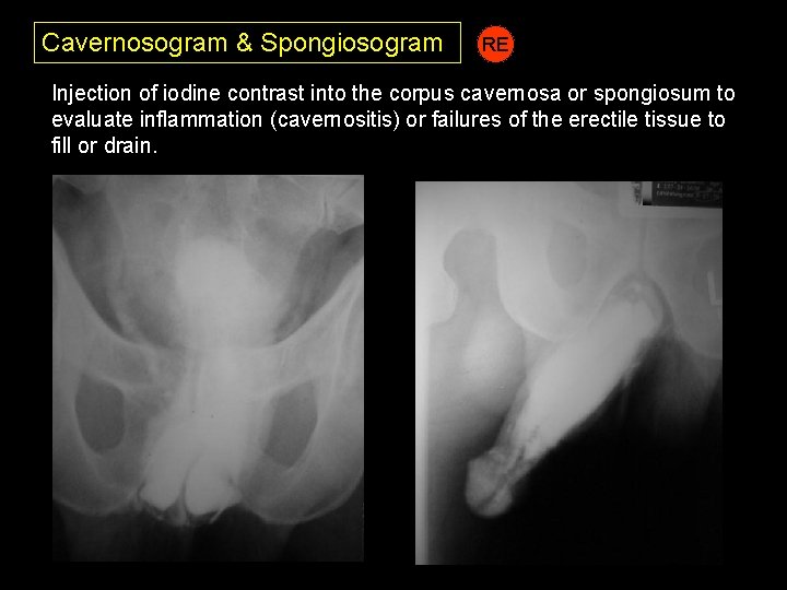 Cavernosogram & Spongiosogram RE Injection of iodine contrast into the corpus cavernosa or spongiosum