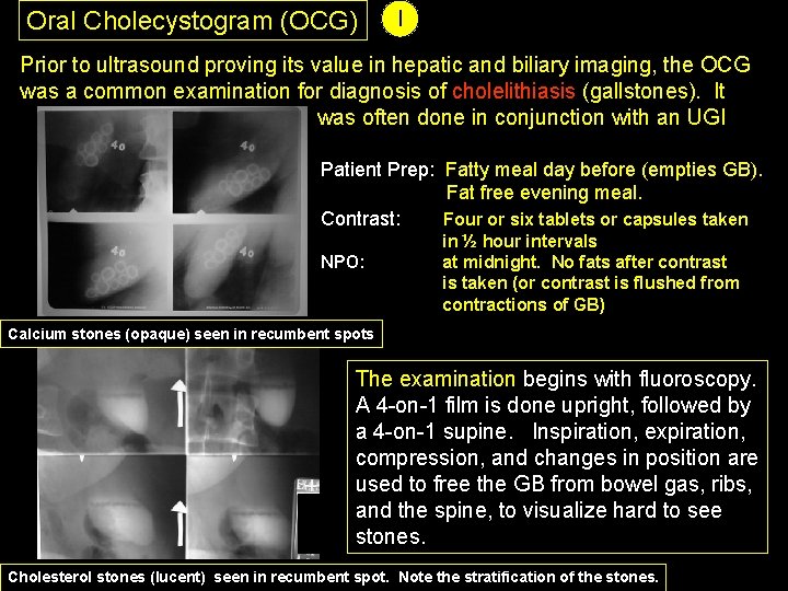 Oral Cholecystogram (OCG) I Prior to ultrasound proving its value in hepatic and biliary