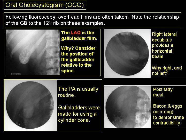 Oral Cholecystogram (OCG) Following fluoroscopy, overhead films are often taken. Note the relationship of