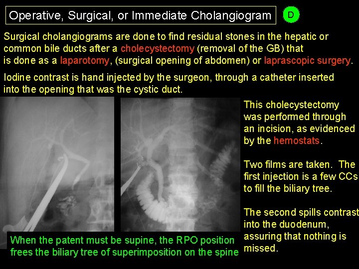 Operative, Surgical, or Immediate Cholangiogram D Surgical cholangiograms are done to find residual stones