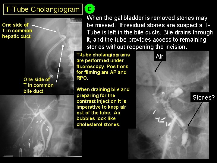 T-Tube Cholangiogram One side of T in common hepatic duct. One side of T