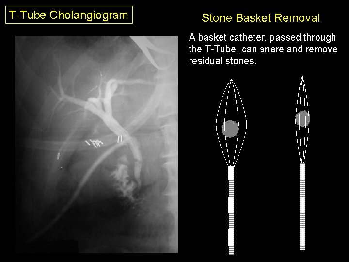 T-Tube Cholangiogram Stone Basket Removal A basket catheter, passed through the T-Tube, can snare