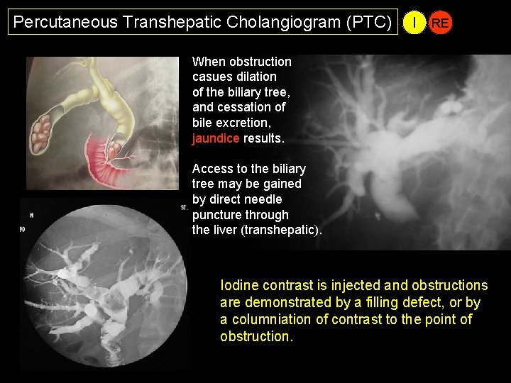 Percutaneous Transhepatic Cholangiogram (PTC) I RE When obstruction casues dilation of the biliary tree,
