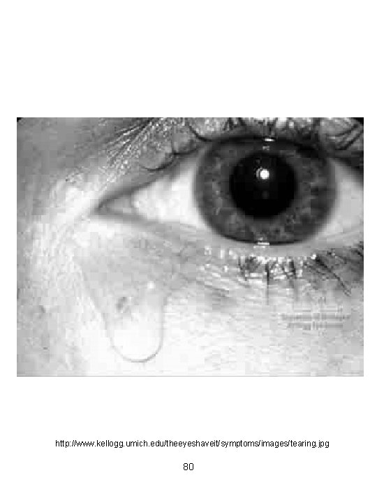 http: //www. kellogg. umich. edu/theeyeshaveit/symptoms/images/tearing. jpg 80 