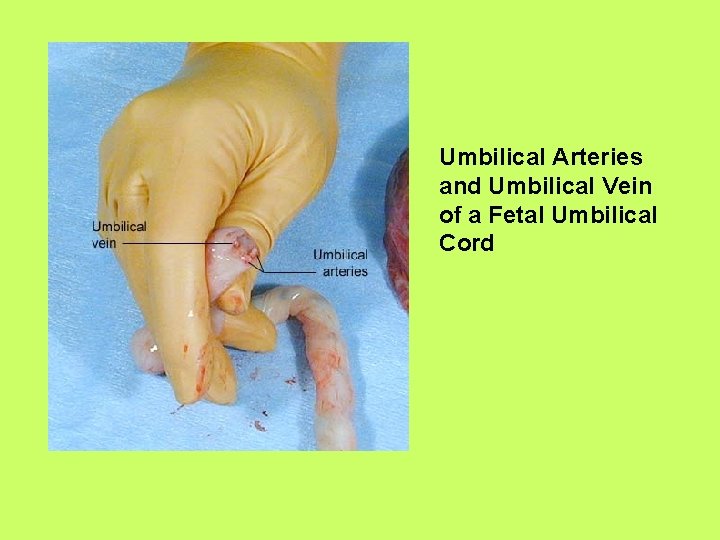 Umbilical Arteries and Umbilical Vein of a Fetal Umbilical Cord 