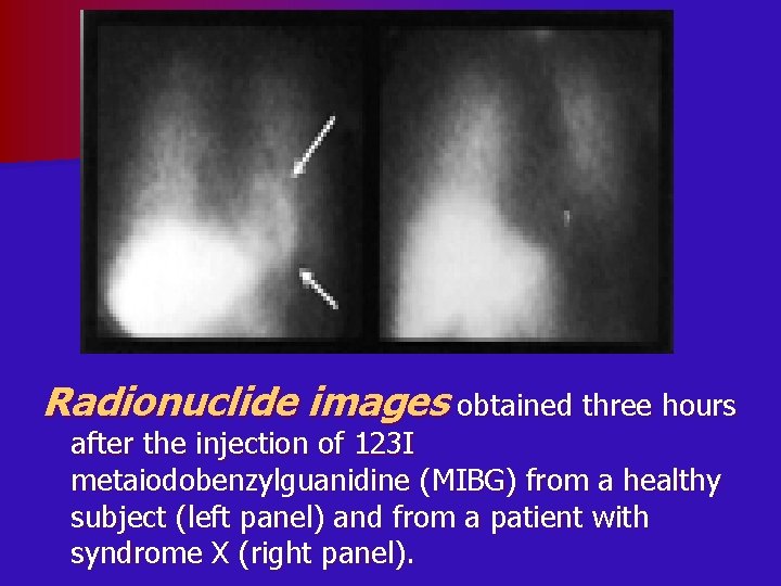 Radionuclide images obtained three hours after the injection of 123 I metaiodobenzylguanidine (MIBG) from