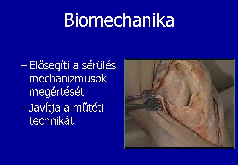Biomechanika – Elősegíti a sérülési mechanizmusok megértését – Javítja a műtéti technikát 