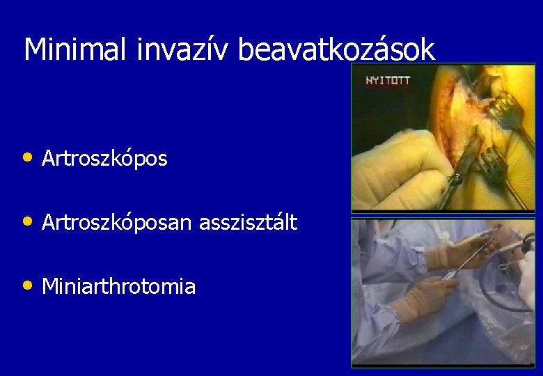 Minimal invazív beavatkozások • Artroszkóposan asszisztált • Miniarthrotomia 