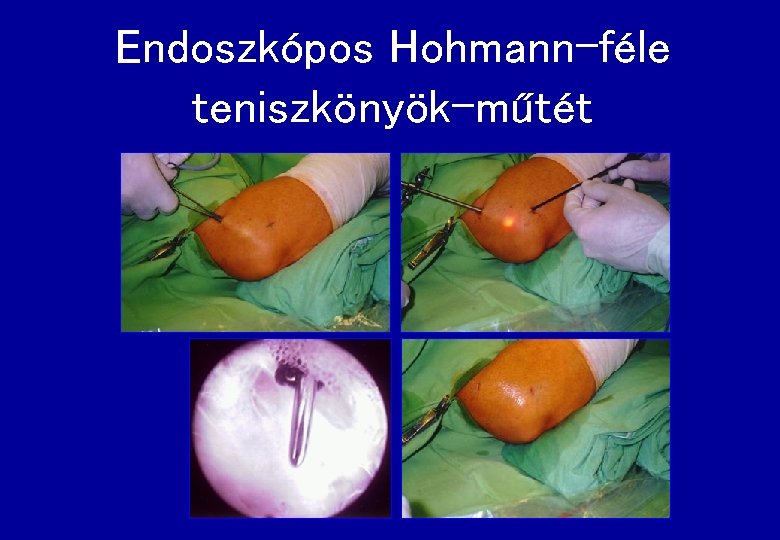 Endoszkópos Hohmann-féle teniszkönyök-műtét 
