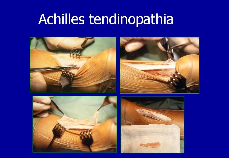 Achilles tendinopathia 