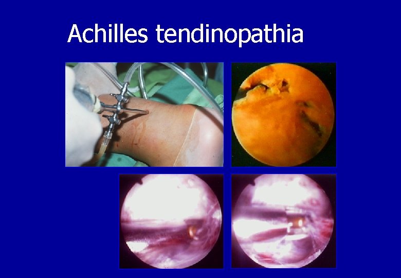 Achilles tendinopathia 