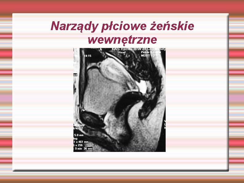 Narządy płciowe żeńskie wewnętrzne Narządy płciowe żeńskie wewnętrzne