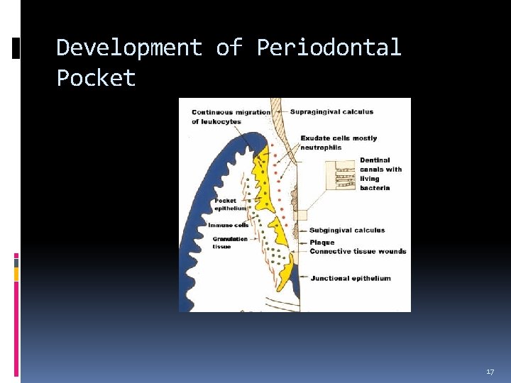 Development of Periodontal Pocket 17 