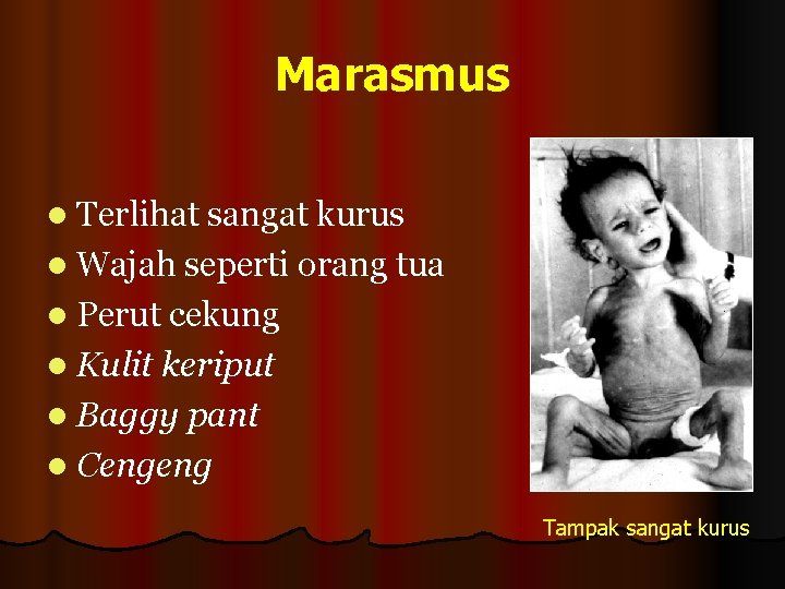 Marasmus l Terlihat sangat kurus l Wajah seperti orang tua l Perut cekung l