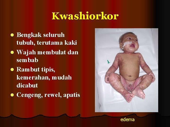 Kwashiorkor l l Bengkak seluruh tubuh, terutama kaki Wajah membulat dan sembab Rambut tipis,