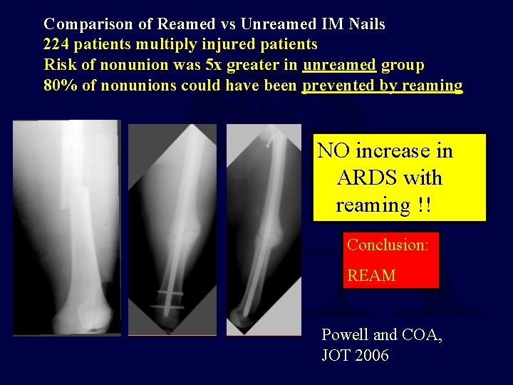 Comparison of Reamed vs Unreamed IM Nails 224 patients multiply injured patients Risk of